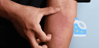 Atopic Dermatitis Bleach Therapy