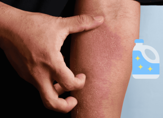 Atopic Dermatitis Bleach Therapy