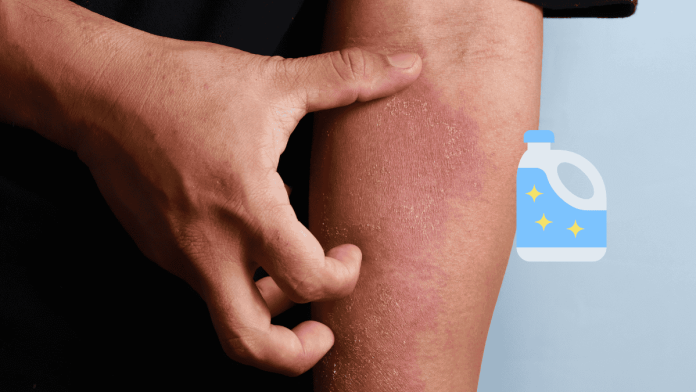 Atopic Dermatitis Bleach Therapy