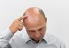 咖啡因洗髮精能改善掉髮嗎?醫:2種人不適合用 Baldness