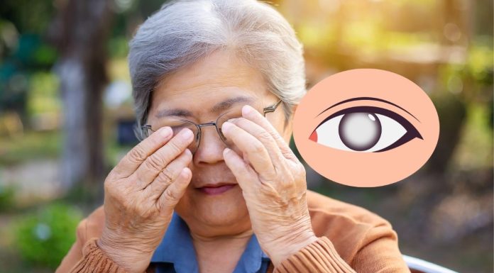 Cataract
