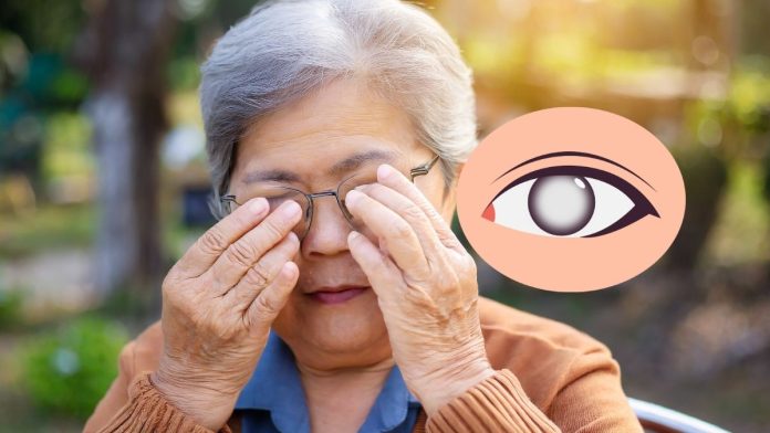 Cataract