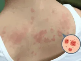 Chronic Urticaria Diagnosis Treatment