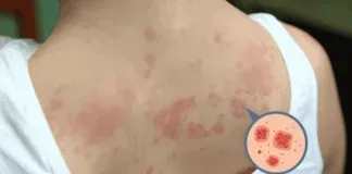 Chronic Urticaria Diagnosis Treatment