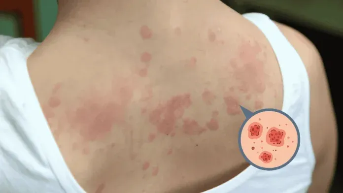 Chronic Urticaria Diagnosis Treatment Chronic Urticaria Diagnosis Treatment