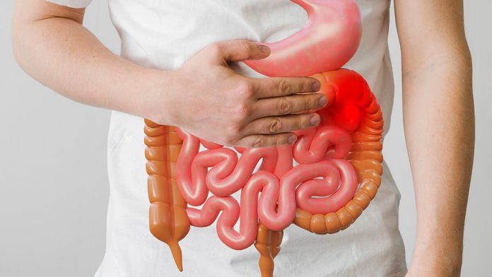 Colon Cancer In Young Adults 1