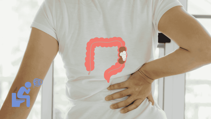 Colon Cancer Lowback
