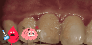 Dental Plaque