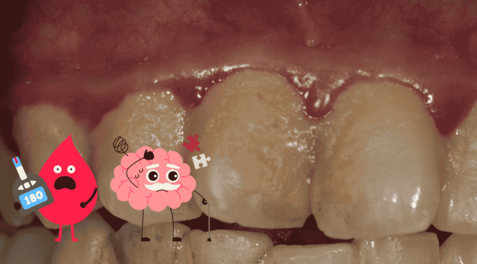 Dental Plaque