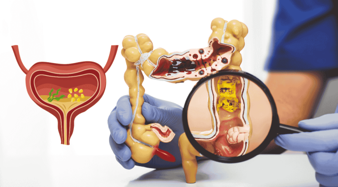 Diverticular Disease