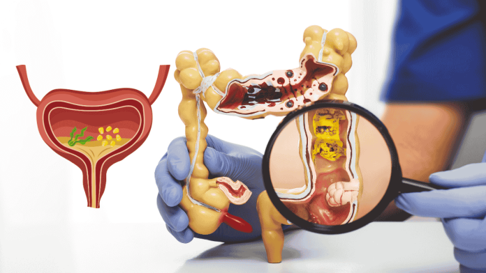 Diverticular Disease