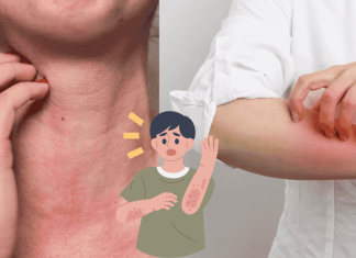 Drug Allergy