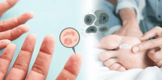 Dyshidrosis Sweat Fungus Prevention