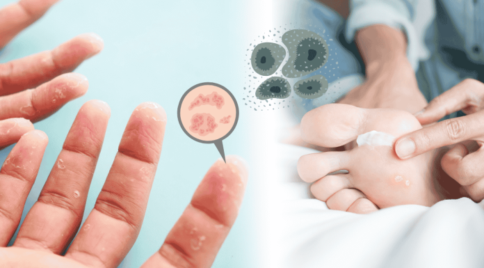 Dyshidrosis Sweat Fungus Prevention