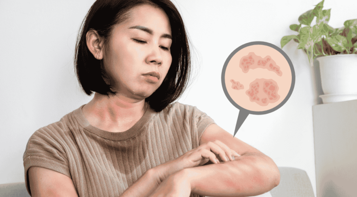 Eczema Spring Prevent