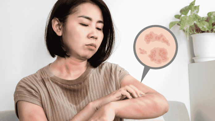 Eczema Spring Prevent