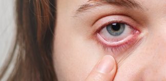 Glaucoma