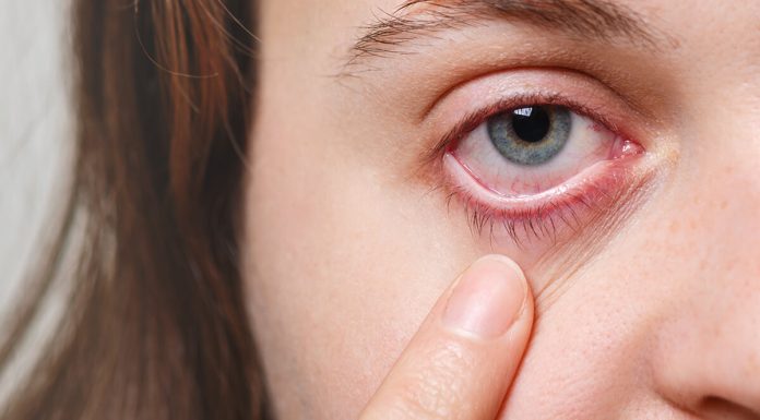 Glaucoma
