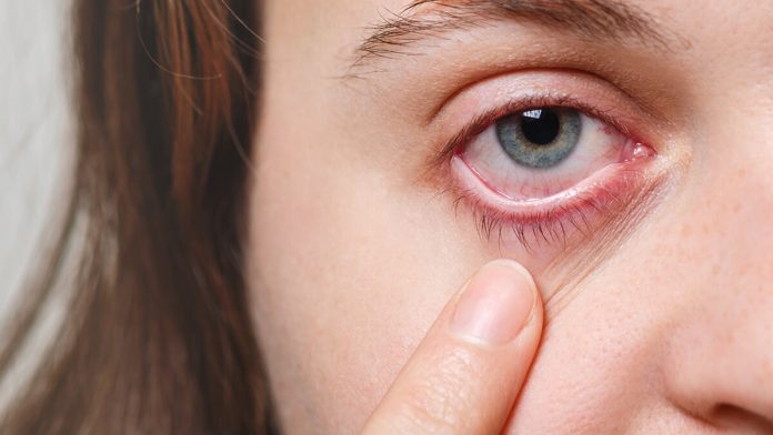 Glaucoma
