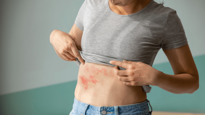 Herpes Zoster