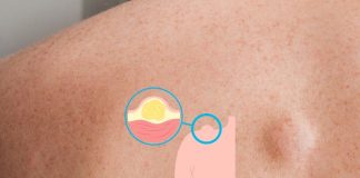 Lipoma