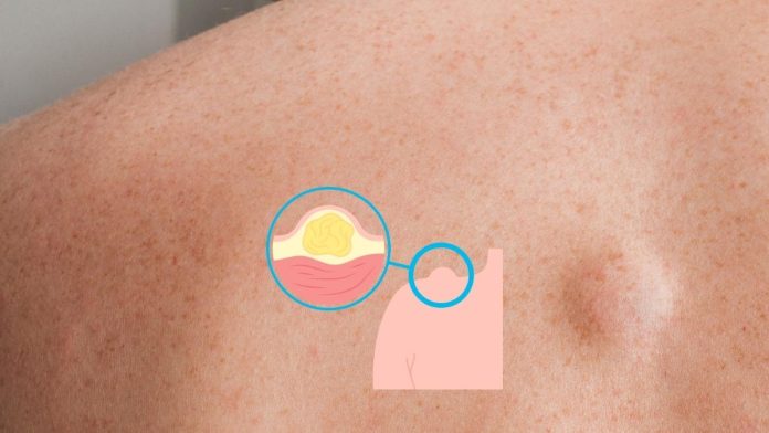 Lipoma