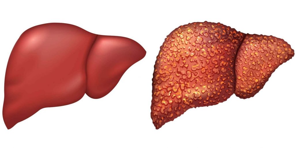 肝炎肝硬化肝癌 ：每30秒有1人因肝炎死亡 肝炎防治不能等！