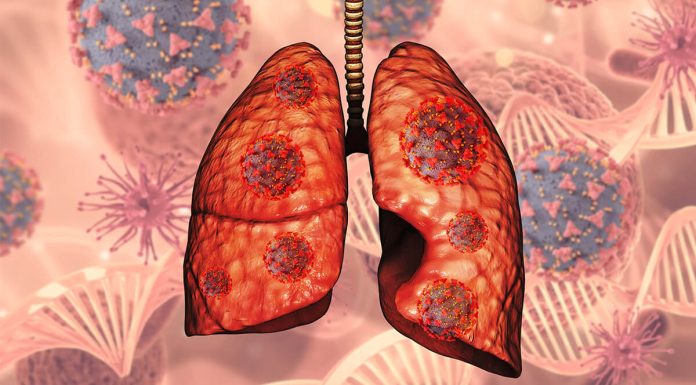 Lung Cancer