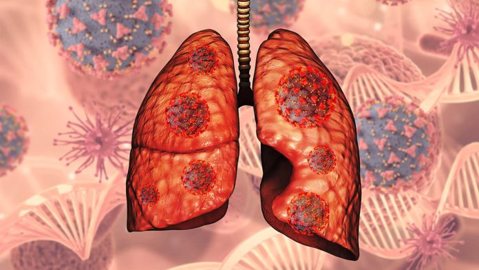 Lung Cancer