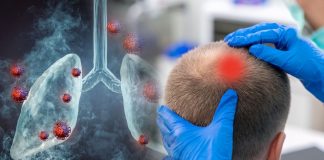 Lung Cancer Scalp Metastasis