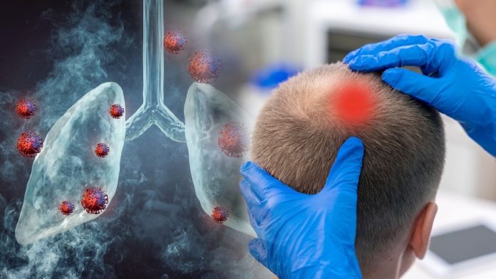 Lung Cancer Scalp Metastasis