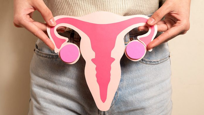 Ovarian Cancer