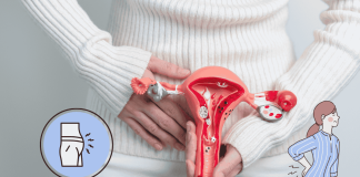 Ovarian Cancer