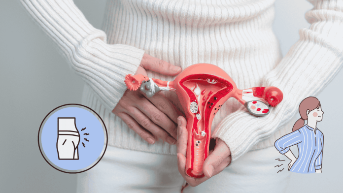 Ovarian Cancer