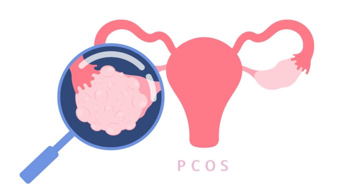 Pcos