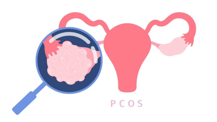 Pcos