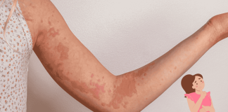 Pregnancy Related Urticaria