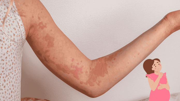 Pregnancy Related Urticaria