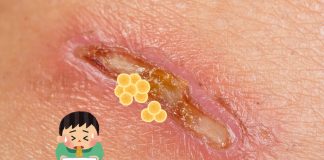 Pus