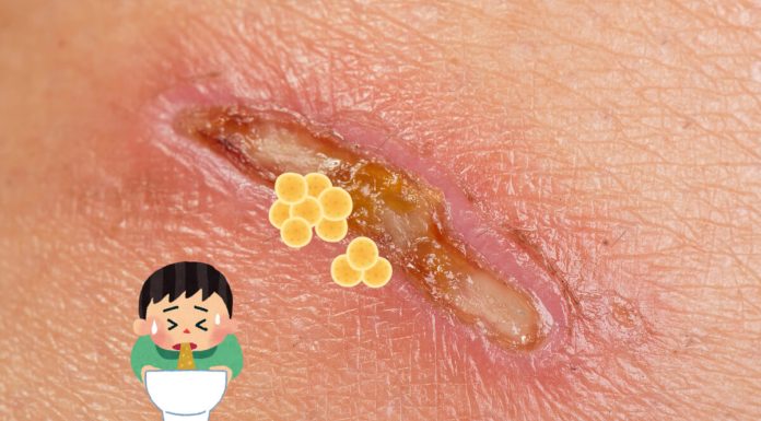 Pus