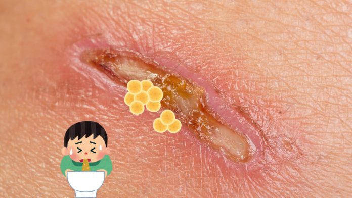 Pus