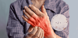 Scabies Symptoms Treatment Parkinsons Link