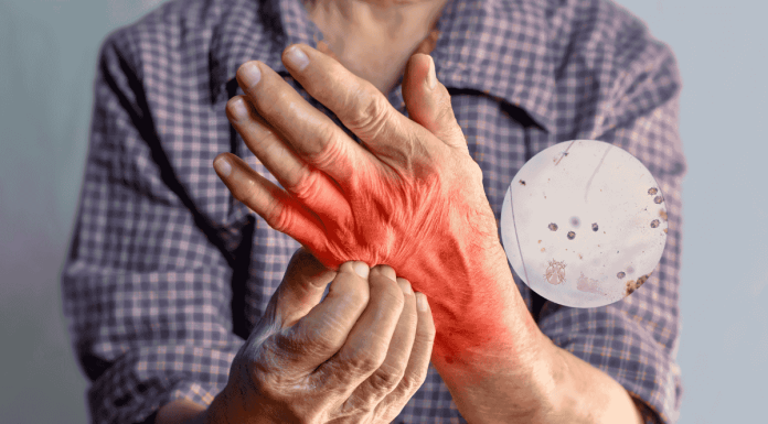 Scabies Symptoms Treatment Parkinsons Link