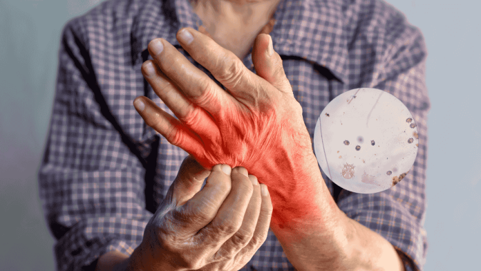 Scabies Symptoms Treatment Parkinsons Link