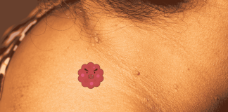 Skin Tags