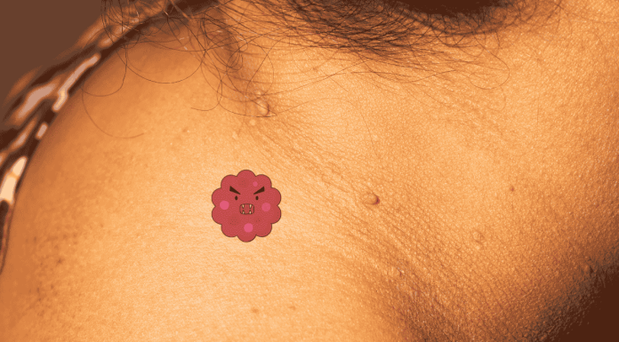 Skin Tags