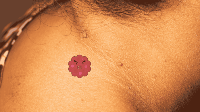 Skin Tags