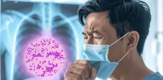 Taiwan First Local Coccidioidomycosis Case