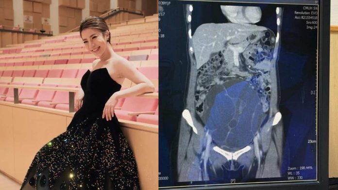 Teacher Chiang Ovarian Tumor