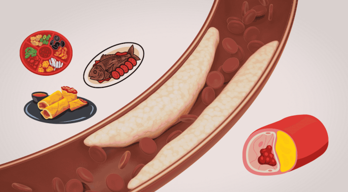 Thrombus